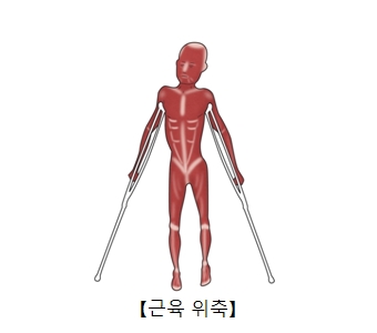 각기병