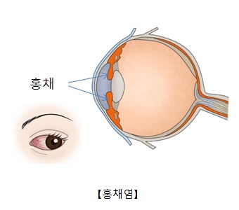 홍채염