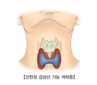 선천성 갑상선 기능 저하증