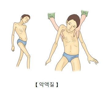 악액질