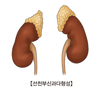 선천성 부신과다 형성증