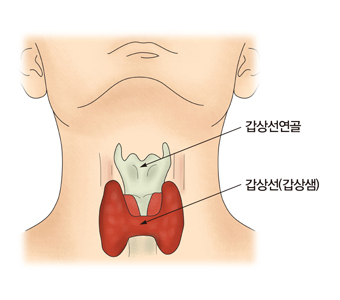 갑상선미분화암