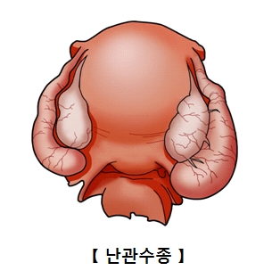 난관수종