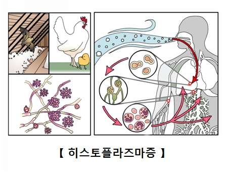 히스토플라즈마증