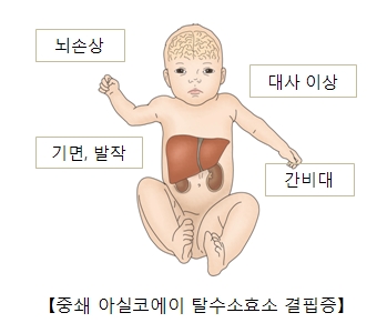 중쇄 아실코에이 탈수소효소 결핍증