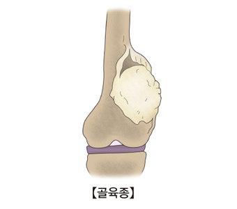 골육종