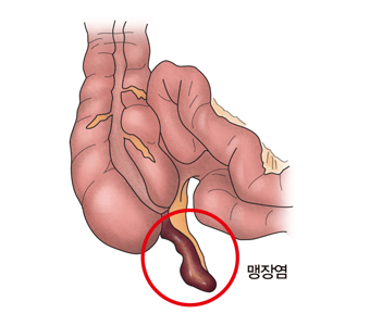 급성 충수염