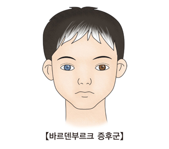 바르덴부르크 증후군