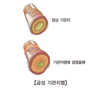 만성 기관지염