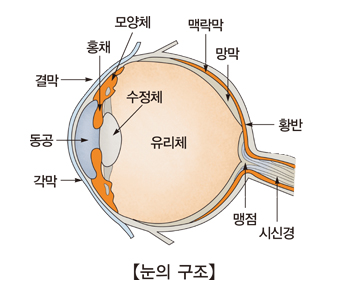 백내장