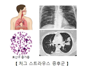 처그 스트라우스 증후군