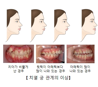 치열 궁 관계 이상