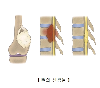 뼈의 신생물