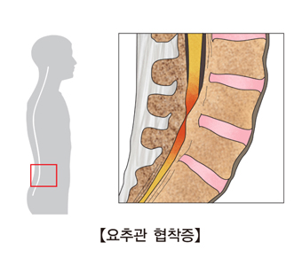 요추관 협착증