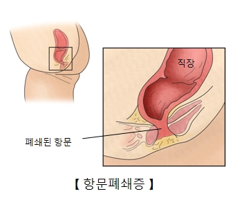 항문폐쇄증