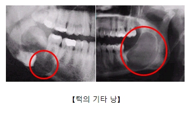 턱의 기타 낭