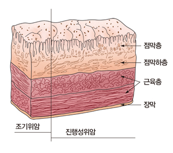 조기 위암