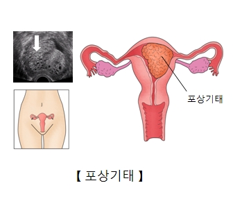 포상기태