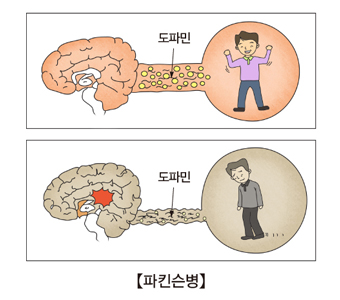 파킨슨증