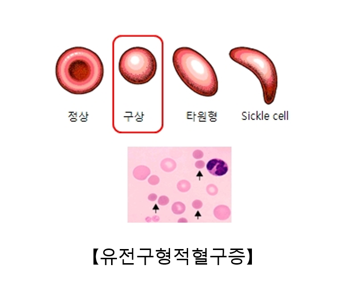 유전성구상적혈구증