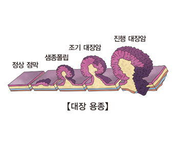 대장의 양성 종양