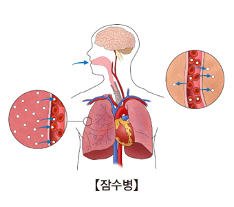 잠수병