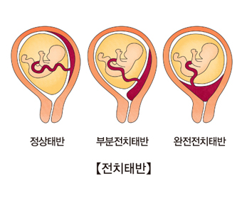 전치 태반