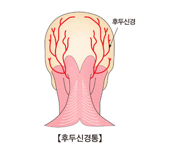 후두신경통