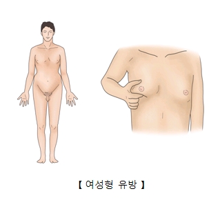 여성형 유방