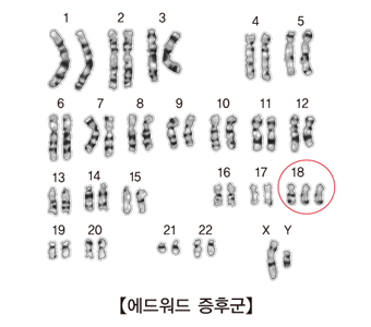 에드워드 증후군