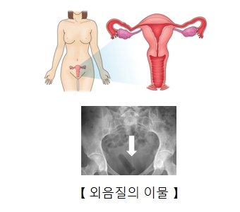 외음질의 이물