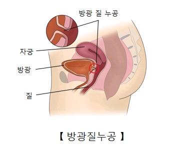 방광질누공을 설명하는 그림